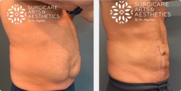 Male Liposuction Before And After With Bodytite and Scar Revision