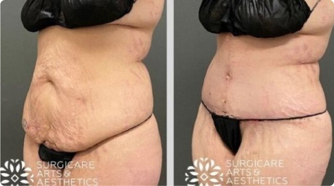 Before and After Fleur de Lis Tummy Tuck