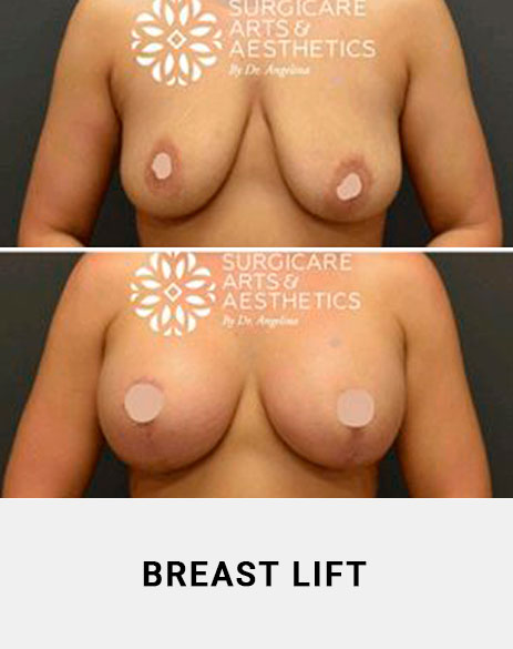 Breast lift Atlanta