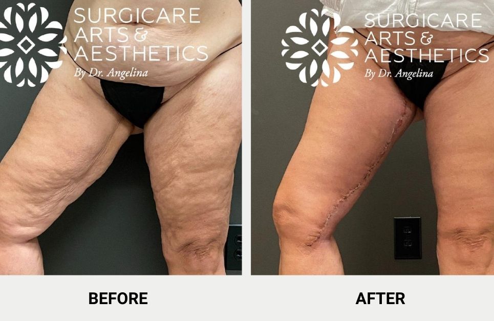 Thigh Lift Scars, What to Expect