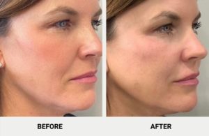 Restylane Vs. Juvederm Vs. Sculptra: Face Dermal Fillers Comparison