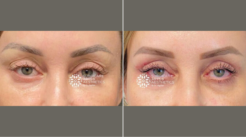 Blepharoplasty Before And After