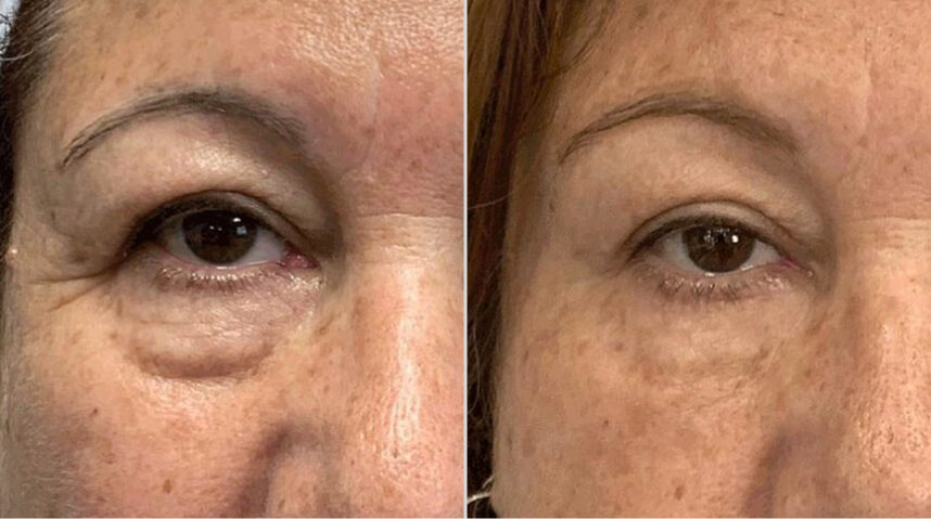 Blepharoplasty Before And After