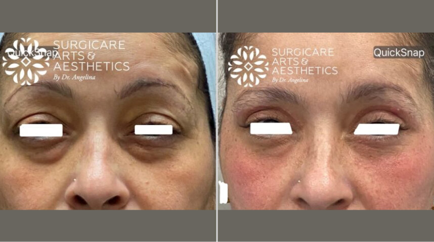 Blepharoplasty Before And After