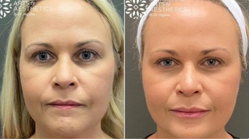 Botox Before And After