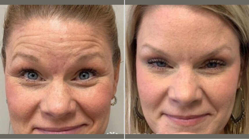 Botox Before And After