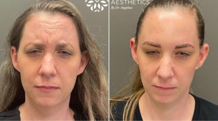 Botox Before And After