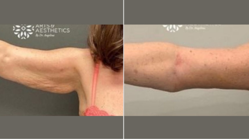 Before And After Brachioplasty (Arm Lift)