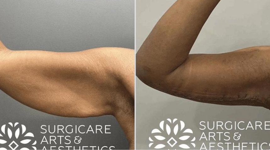 Before And After Brachioplasty (Arm Lift)