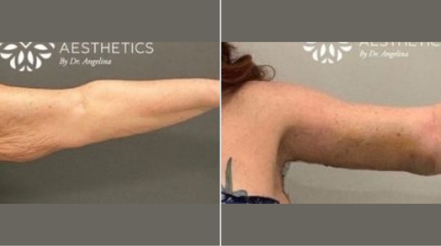 Before And After Brachioplasty (Arm Lift)