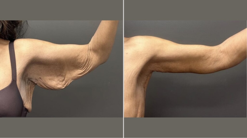 Before And After Brachioplasty (Arm Lift)