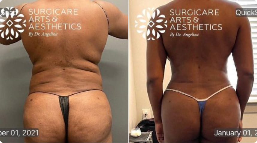 Brazilian Butt Lift Before And After