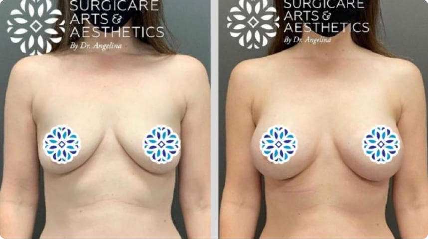 Before And After Breast Augmentation