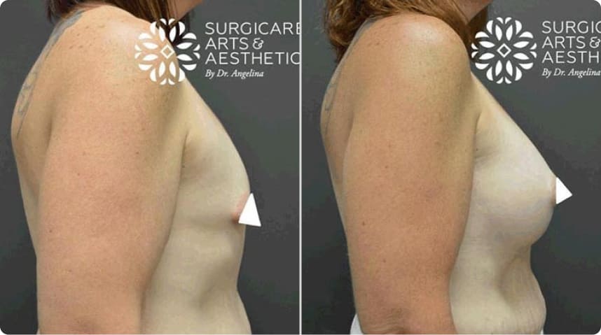Before And After Breast Augmentation
