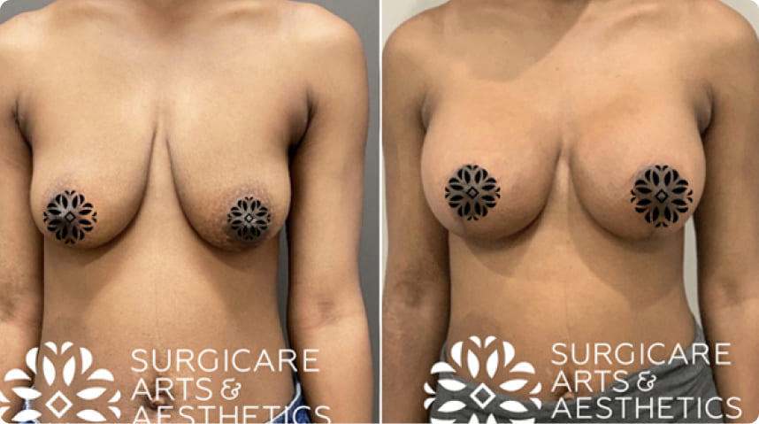 Before And After Breast Lift