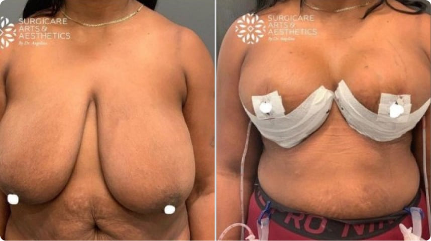 Before and After Breast Reduction