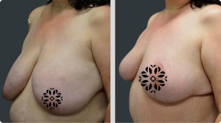 Before and After Breast Reduction