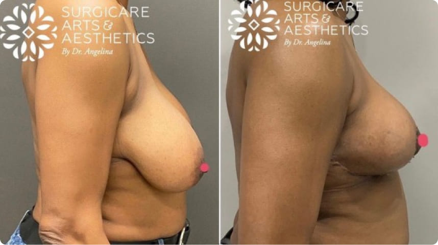 Before and After Breast Reduction