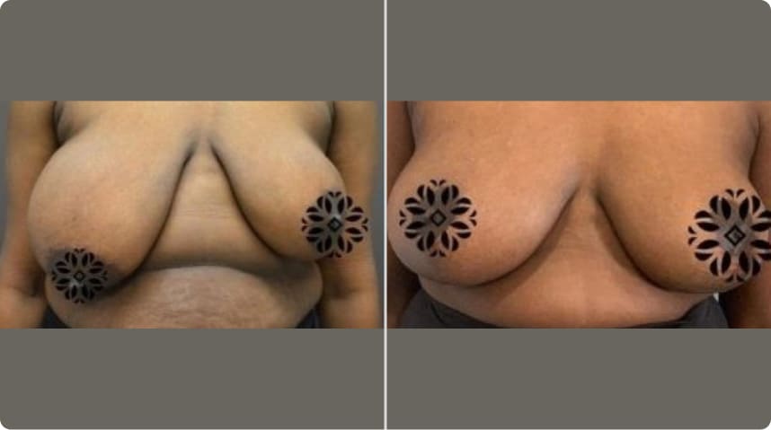 Before and After Breast Reduction