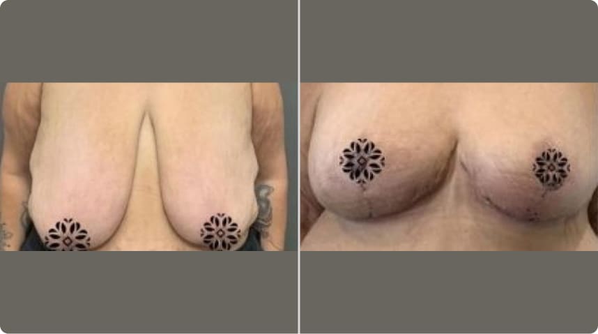 Before and After Breast Reduction