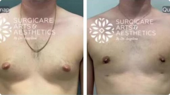 Gynecomastia Before And After