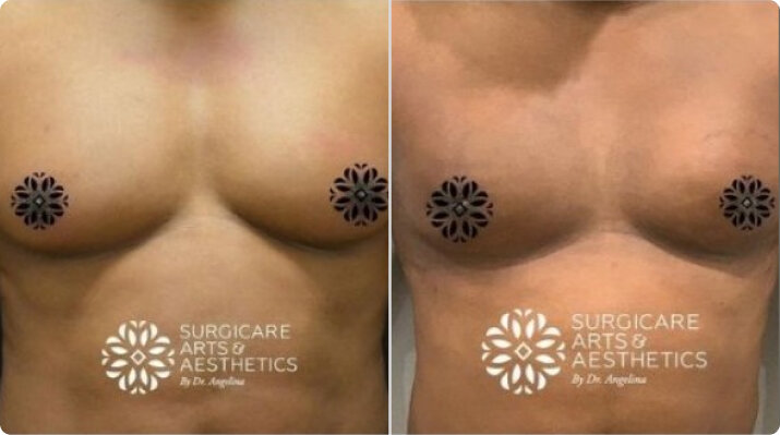 Gynecomastia Before And After