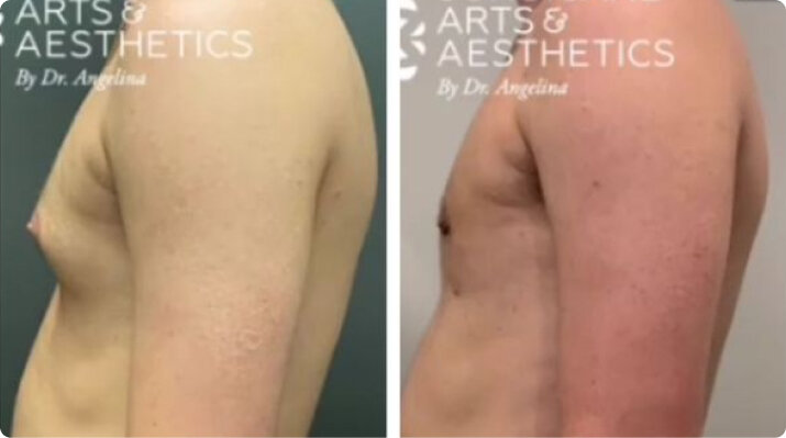 Gynecomastia Before And After