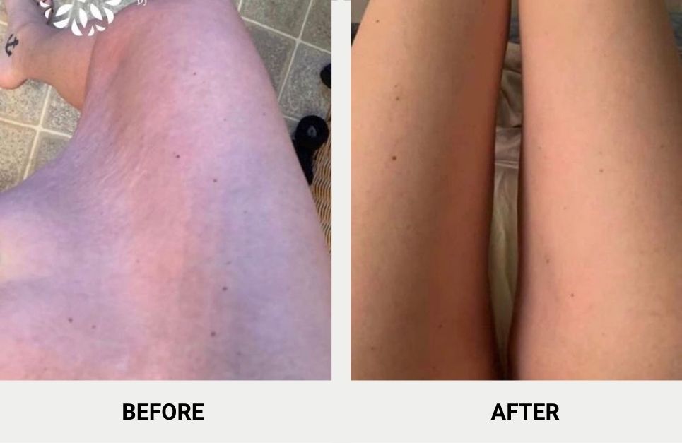 Is Inner Thigh Lift Worth It? Recovery, Scars, Results, and More