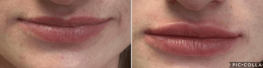 Before And After Lip Fillers