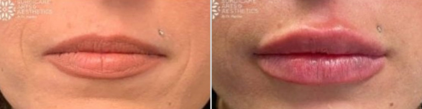 Before And After Lip Fillers