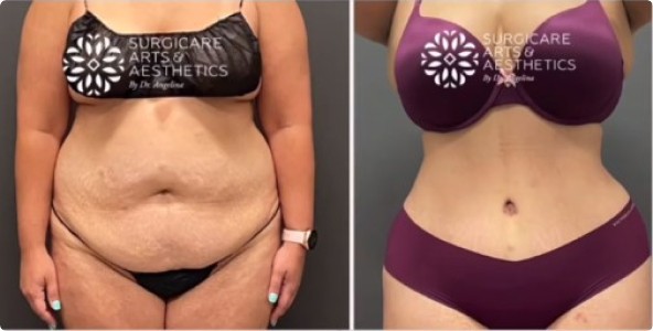 Liposuction Before and After – Pictures After 1 Week and 1 Month