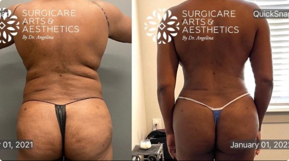 Liposuction Before and After – Pictures After 1 Week and 1 Month
