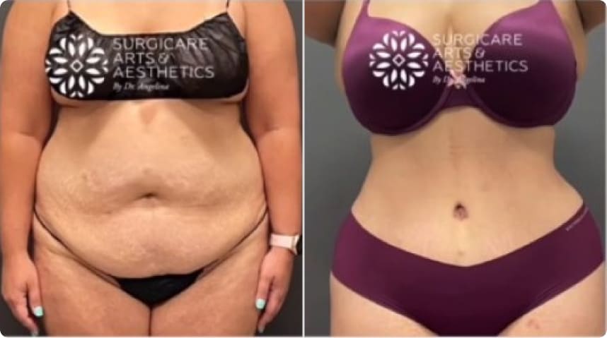 Before And After Liposuction