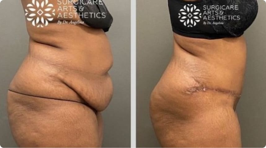 Before And After Liposuction