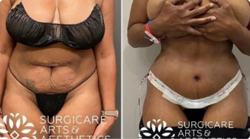 Before And After Liposuction