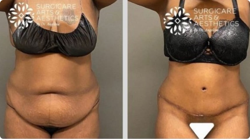 Before And After Liposuction