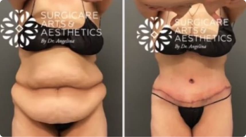 Before And After Liposuction