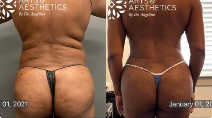 Before And After Liposuction