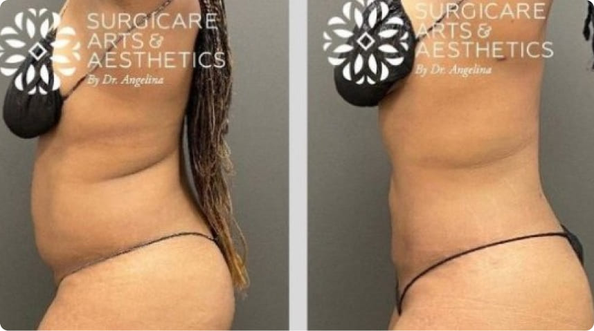 Before And After Liposuction