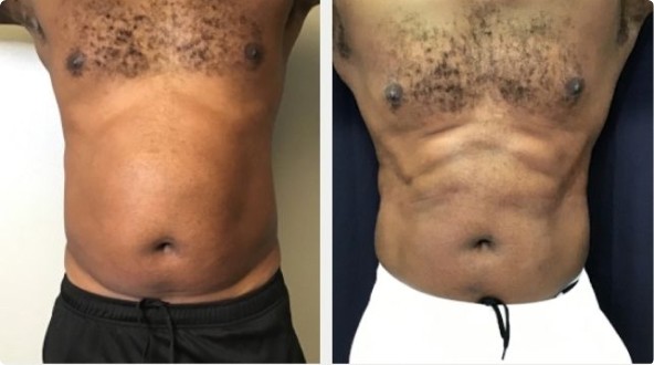 Exclusive Before & After Physiq Body Treatments