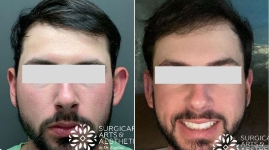 Before And After Otoplasty