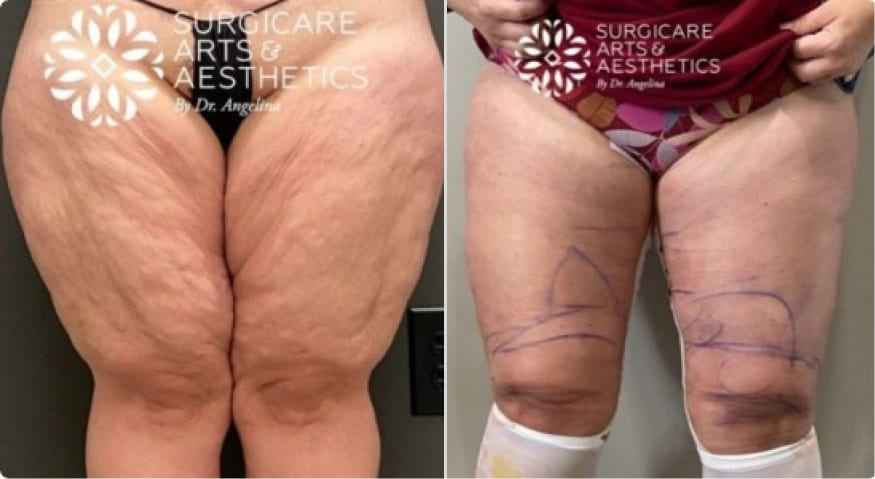 Before And After Thigh Lift