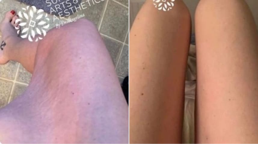 Before And After Thigh Lift