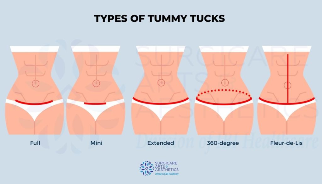 Types of Tummy Tuck Procedures and Scar Care