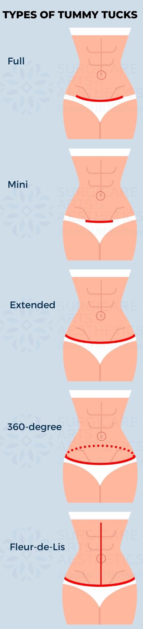 What is the Difference between Belt Lipectomy & Tummy Tuck? 