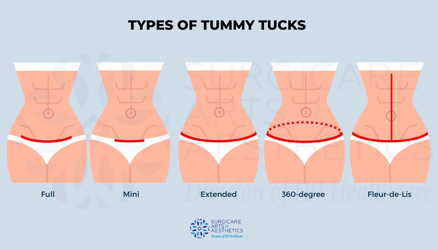 All about Fleur-De-Lis tummy tucks.